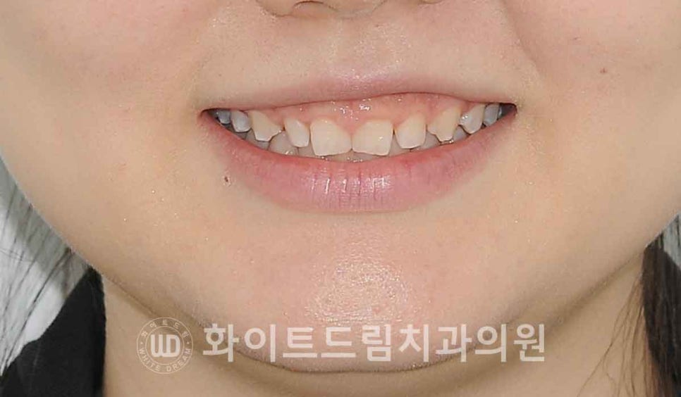 강남역 잇몸성형, 라미네이트와 흔히 동반되는 관련 이미지 3