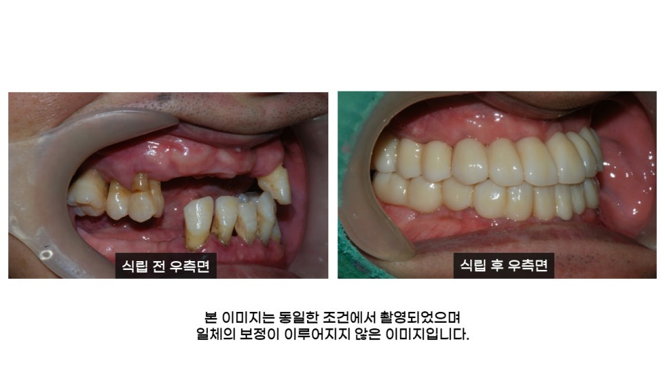 40대임플란트식립후기 및 어금니임플란트 가격, 종류 알아보기 위해 관련 이미지 16