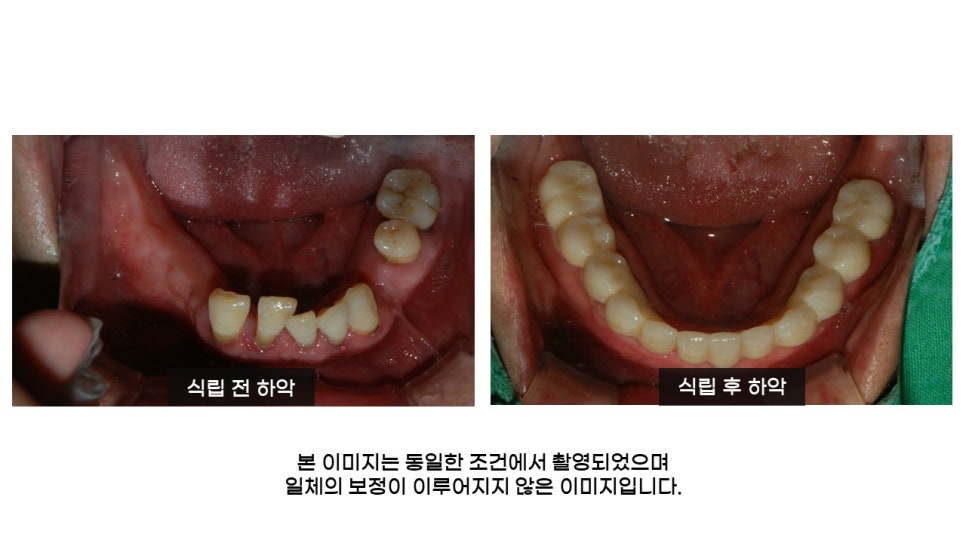 40대임플란트식립후기 및 어금니임플란트 가격, 종류 알아보기 위해 관련 이미지 19