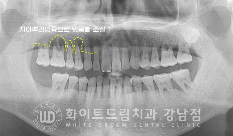 발치 즉시 임플란트 "내원 당일 발치 후 바로 임플란트 식립!" 관련 이미지 7