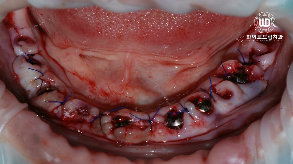 전체임플란트 식립 및 임플란트뼈이식 후기 관련 이미지 3