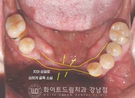 치주염 전체임플란트, 염증으로 인한 상악동 천공 & 신경관 가까이 녹은 잇몸뼈. 임플란트 식립 가능할까? 관련 이미지 7