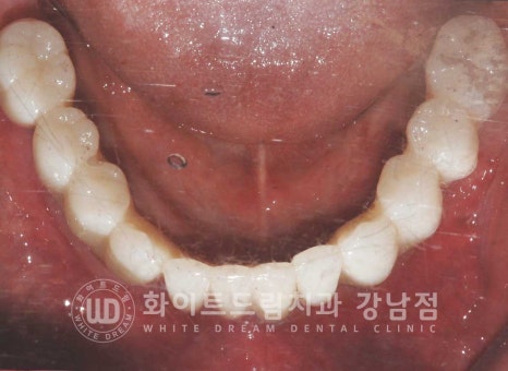 전체 임플란트 치료 기간과 내원 횟수는? "치과에 자주 가기 어려워요." 관련 이미지 25