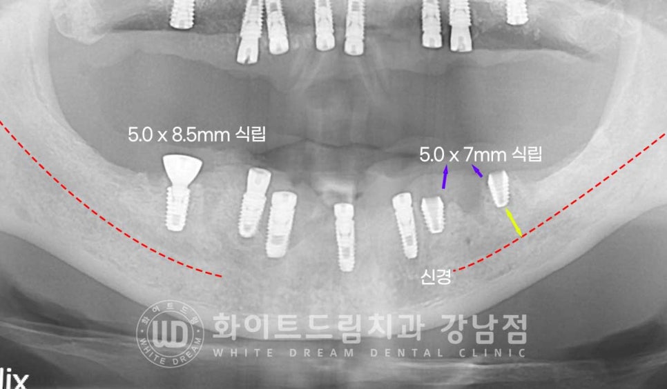 치주염 전체임플란트, 염증으로 인한 상악동 천공 & 신경관 가까이 녹은 잇몸뼈. 임플란트 식립 가능할까? 관련 이미지 13