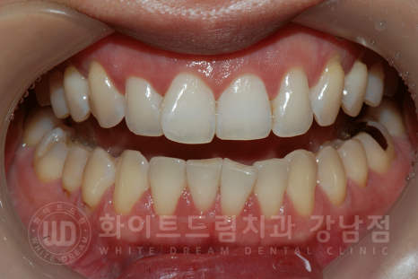 강남역 앞니라미네이트 "틀어진 토끼 앞니 빠르게 개선" 강남역 라미네이트 치과 관련 이미지 4