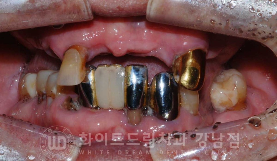 전체 임플란트 치료 기간과 내원 횟수는? "치과에 자주 가기 어려워요." 관련 이미지 8