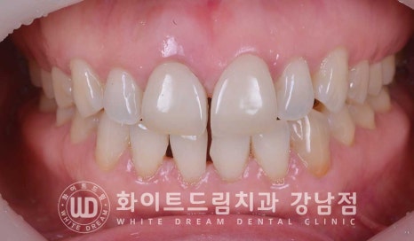 벌어진 앞니 라미네이트 / 50대 시니어 라미네이트 치료 사례 관련 이미지 2