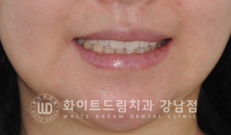 신경치료 후 크라운을 씌워야 하는 이유 & 신경치료 후 변색 치료 Case 리뷰 관련 이미지 3