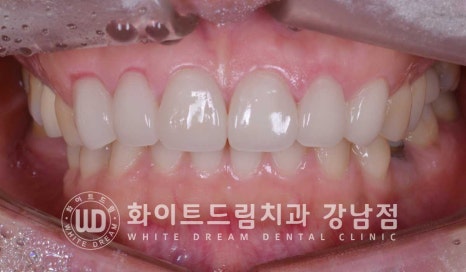 앞니 원데이라미네이트, 뻐드러지고 벌어진 앞니! 당일 치료 ok 관련 이미지 6