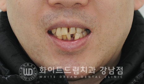 40대 전체임플란트 / 디지털스캔바디를 이용한 전체 임플란트 치료 사례 (Feat. 치주염) 관련 이미지 1