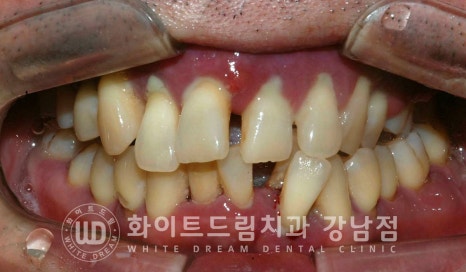 40대 전체임플란트 / 디지털스캔바디를 이용한 전체 임플란트 치료 사례 (Feat. 치주염) 관련 이미지 9