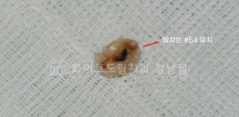 영구치 결손, "유치가 흔들려요." 성인 잔존 유치 발치 후 바로 임플란트 식립! 관련 이미지 6