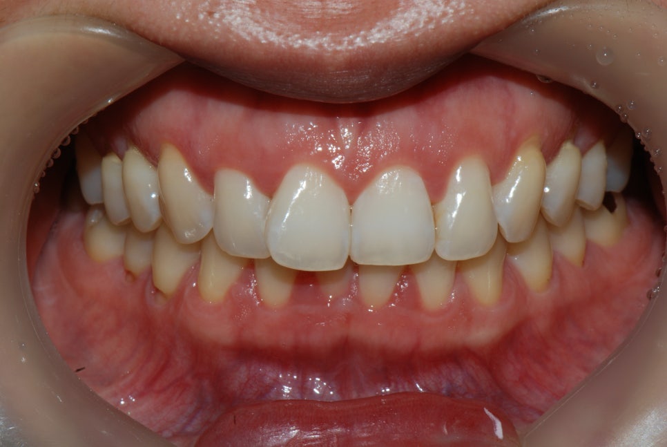 강남역 앞니라미네이트 "틀어진 토끼 앞니 빠르게 개선" 강남역 라미네이트 치과 관련 이미지 1