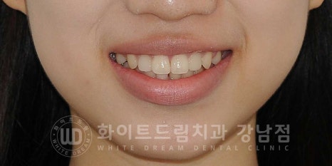 역삼역 왜소치치료 / 치아 하나가 너무 작아요. 왜소치 라미네이트 잘하는 치과 관련 이미지 5