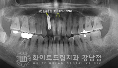 사고당한 앞니치료, "흔들리고 점점 변색돼요." 앞니 임플란트 & 신경치료 관련 이미지 10