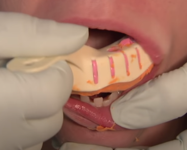 임플란트 하기 전 알아보아야 할 것. 관련 이미지 10