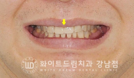벌어지고 깨진 앞니, 웨딩 앞니 라미네이트 치료 사례 "남자도 자연스럽게 라미네이트 가능한가요?" 관련 이미지 15