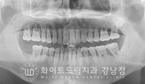 발치 즉시 임플란트 "내원 당일 발치 후 바로 임플란트 식립!" 관련 이미지 4