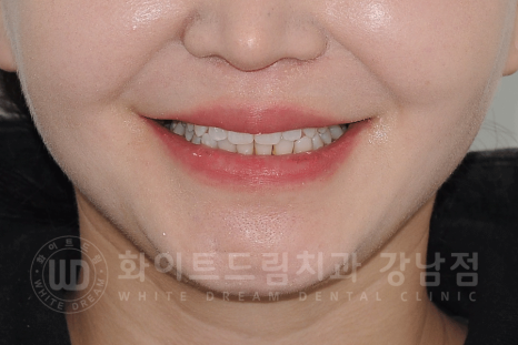 강남역 원데이 라미네이트 "유튜브 촬영하는데 치아가 신경 쓰여요" #강남화이트드림치과 관련 이미지 4