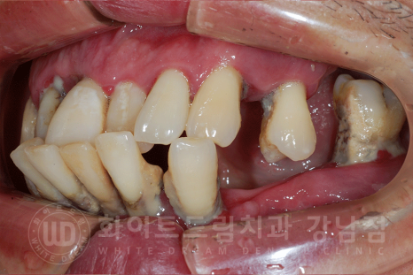 강남역 전체임플란트 치과 "치아가 심하게 흔들려요." 심한 치주염 임플란트 치료 관련 이미지 21