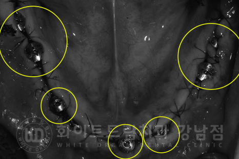강남역 전체임플란트 치과 "치아가 심하게 흔들려요." 심한 치주염 임플란트 치료 관련 이미지 13
