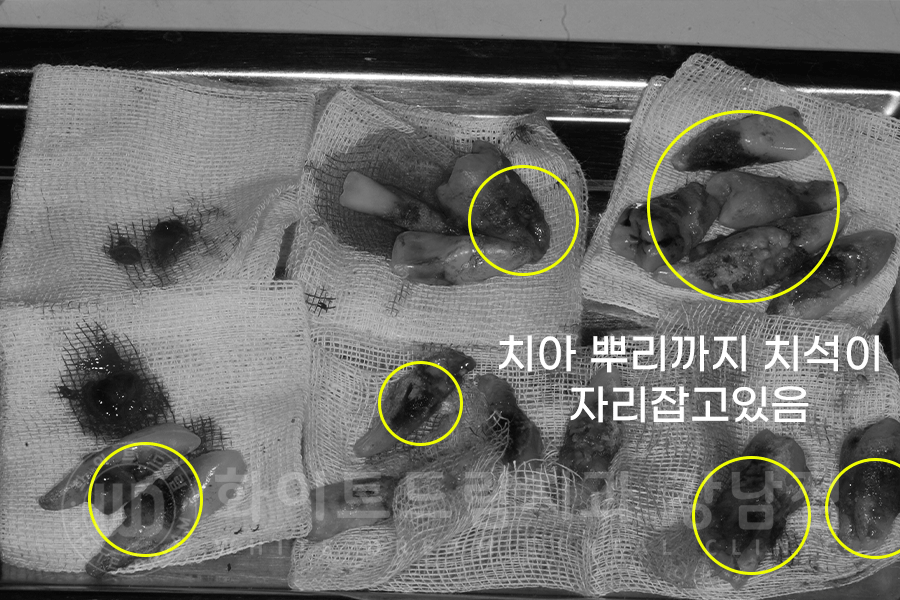 강남역 전체임플란트 치과 "치아가 심하게 흔들려요." 심한 치주염 임플란트 치료 관련 이미지 5