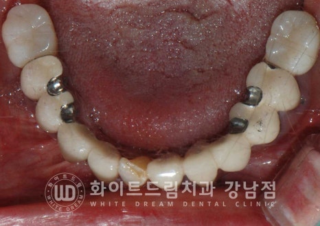 상악 풀케이스임플란트 사례 "부산에서 강남까지 왔어요" 관련 이미지 21