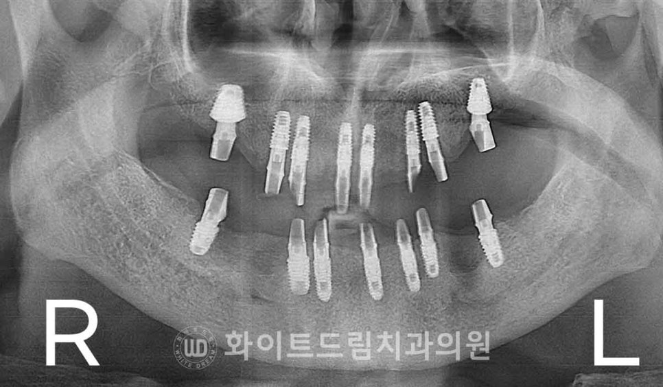 서울전체임플란트잘하는치과, 왜 치주염이 심해지면 반대교합까지 생길까요? (치주염 전체 임플란트 CASE) 관련 이미지 16
