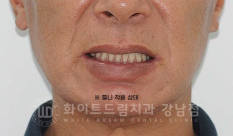 임플란트 재수술 잘하는치과 / 재수술과 전체 임플란트 치료를 동시에! 관련 이미지 12