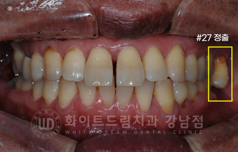 서초동 어금니 임플란트 / 강남역 화이트드림치과 : 상악동 거상술 (crestal approch) 관련 이미지 6