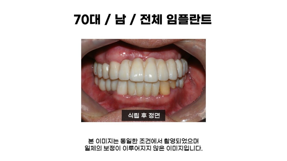 고연령 전체임플란트 과정 및 임플란트 치료기간, 전체임플란트식립후기 관련 이미지 5