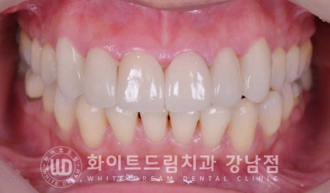 앞니 뻐드러짐 라미네이트 "뻐드러지고 벌어진 앞니" 당일 라미네이트 치료 case 관련 이미지 4