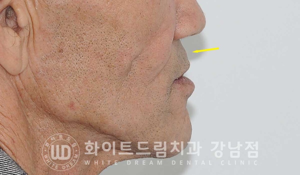 전체 임플란트 치료 기간과 수술 후 나타나는 변화는? 관련 이미지 19