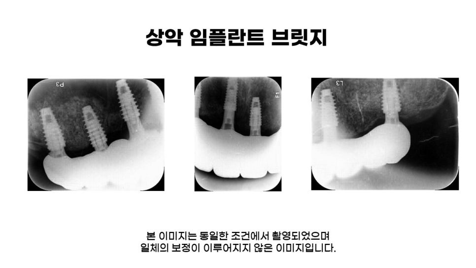 어금니임플란트 수복 및 당뇨환자임플란트 가격, 종류, 통증 관련 이미지 16