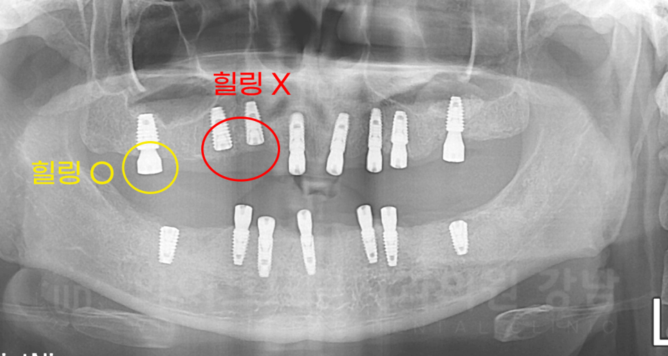 강남역 임플란트 치과 "틀니가 안 맞아서 불편해요" 틀니 → 전체 임플란트로! 관련 이미지 16