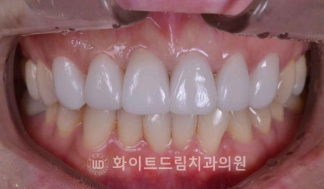 뱅뱅사거리치과 "라미네이트가 마음에 들지 않아요. 하얗고 균일한 치아를 갖고 싶어요." 강남역 화이트드림치과 관련 이미지 10