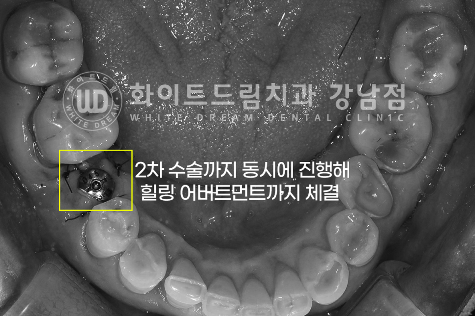 강남역 임플란트치과 / "어금니가 없고 이갈이가 심해요" 강남역 화이트드림치과 관련 이미지 6