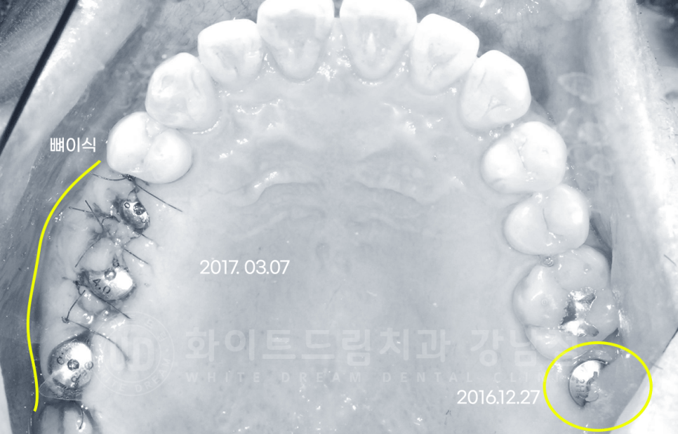 서초동 어금니 임플란트 / 강남역 화이트드림치과 : 상악동 거상술 (crestal approch) 관련 이미지 9