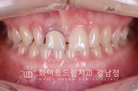 벌어진 앞니라미네이트 / "왜소치로 치아가 벌어졌어요" 치료 사례 관련 이미지 1