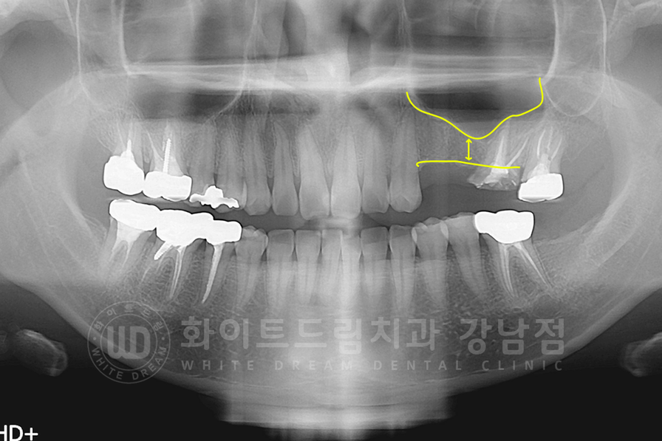 강남역 어금니 임플란트 "어금니가 부러졌어요" 상악동 거상술(lateral approach) 관련 이미지 5