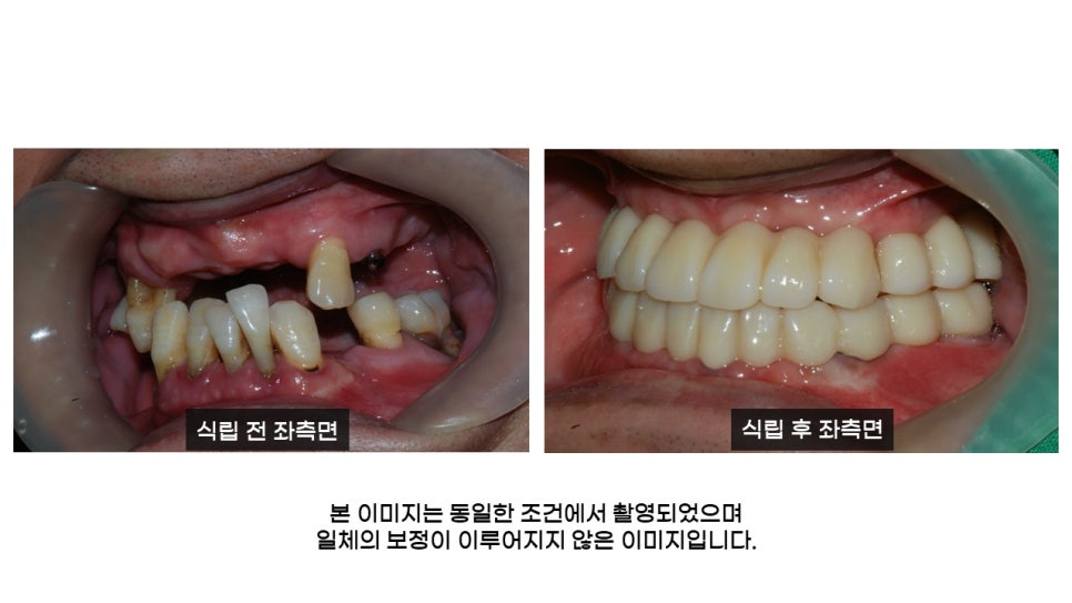 40대임플란트식립후기 및 어금니임플란트 가격, 종류 알아보기 위해 관련 이미지 17