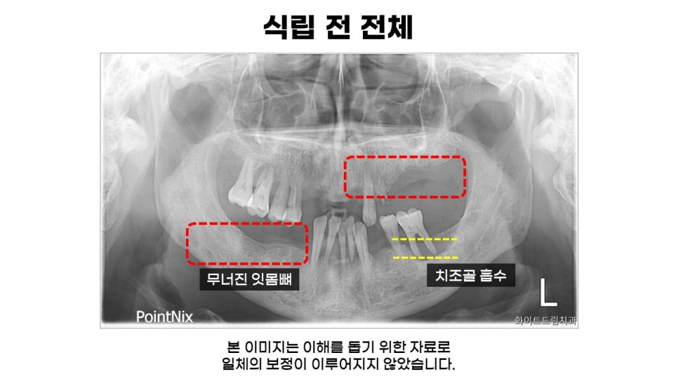 40대임플란트식립후기 및 어금니임플란트 가격, 종류 알아보기 위해 관련 이미지 4