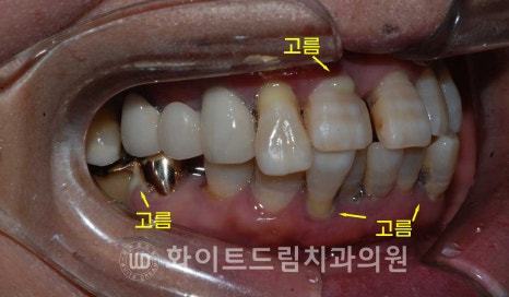 강남역전체임플란트 / 발치 후 즉시 식립, 무조건 누구나 3개월로 끝낼 수 있는 것일까? 강남역화이트드림치과 관련 이미지 7