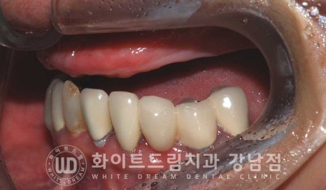 상악 풀케이스임플란트 사례 "부산에서 강남까지 왔어요" 관련 이미지 8