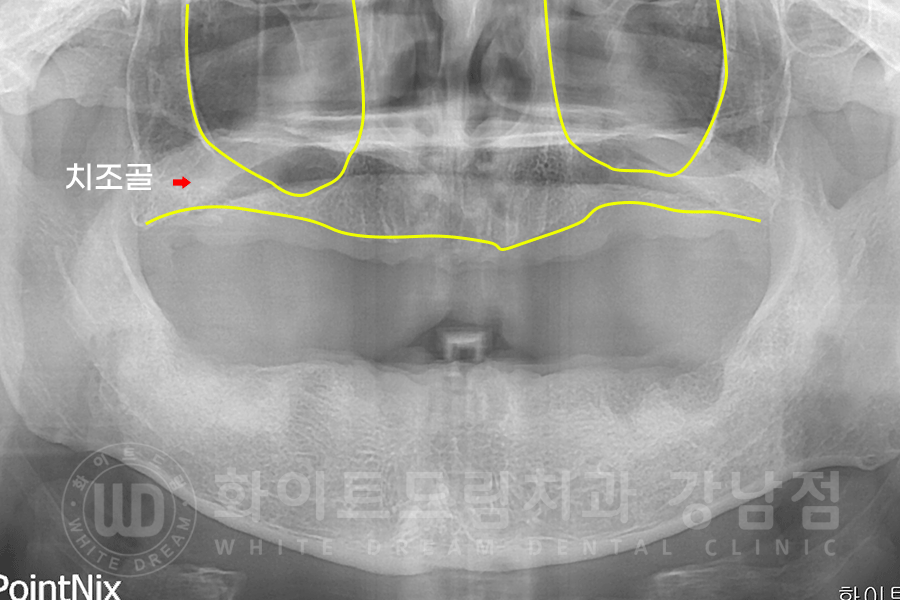 강남역 전체임플란트 치과 "치아가 심하게 흔들려요." 심한 치주염 임플란트 치료 관련 이미지 7