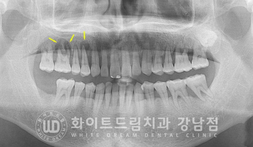 발치 즉시 임플란트 "내원 당일 발치 후 바로 임플란트 식립!" 관련 이미지 6