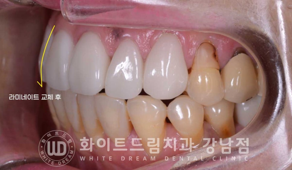 앞니라미네이트 교체 "5년 전에 한 라미네이트가 뻗쳐 보여요" 예쁘게 치료할 수 있나요? 관련 이미지 12