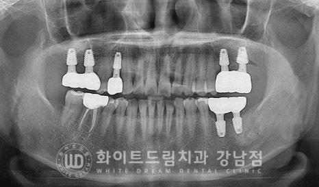 신경치료 후 크라운을 해야 하는 이유 / 크라운을 안 해 부러진 치아 임플란트 치료 case 관련 이미지 7