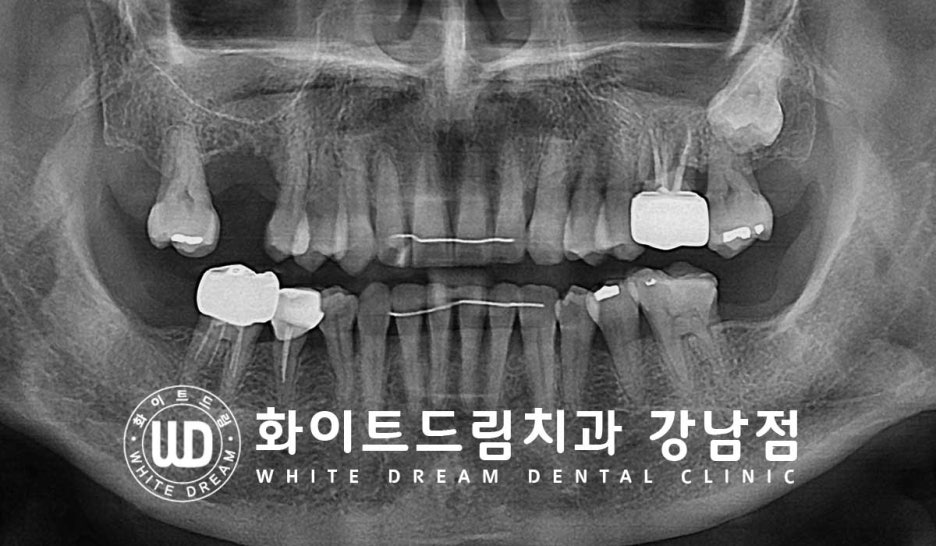Why You Must Know About "Sinus Lift" Before Upper Molar Implants image 8