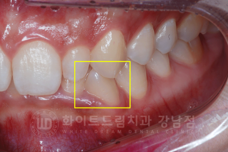 신논현역 라미네이트 / 과개교합 치아교정 + 왜소치 라미네이트 진행 case 관련 이미지 6